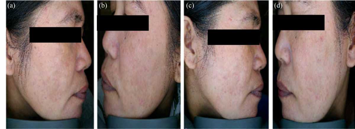Image for - Efficacy of Micro-Needling with Topical Vitamin C and E Serum Versus Micro-Needling Alone in Recalcitrant Facial Melasma