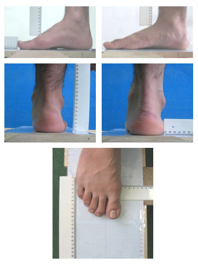 Image for - Foot Anthropometry of 18-25 Years Old Iranian Male Students