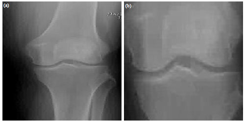 Image for - Local Binary Pattern Approach to the Classification of Osteoarthritis in Knee X-ray Images