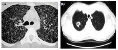 Image for - An Efficient ANFIS based Approach for Screening of Chronic Obstructive Pulmonary Disease (COPD) from Chest CT Scans with Adaptive Median Filtering