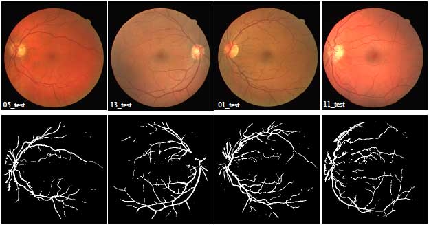 Image for - Automatic Segmentation of Retinal Blood Vessels of Diabetic Retinopathy Patients using Dempster-shafer Edge Based Detector