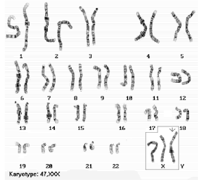 Image for - Detection of Specific Human Chromosomal Abnormalities Using Discrete Cosine Transform Based Gradient Vector Flow Active Contours