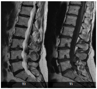 Image for - Osteoporosis and Non Specific Chronic Low Back Pain: Correlation with Sex and Severity of Backache