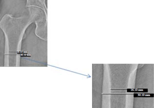 Image for - Low Bone Mass Estimation: The Exhibition of Semi-automated Approach over the Manual Method in a Comparative Perspective With DXA