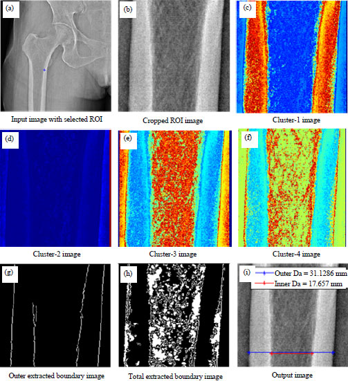 Image for - Low Bone Mass Estimation: The Exhibition of Semi-automated Approach over the Manual Method in a Comparative Perspective With DXA