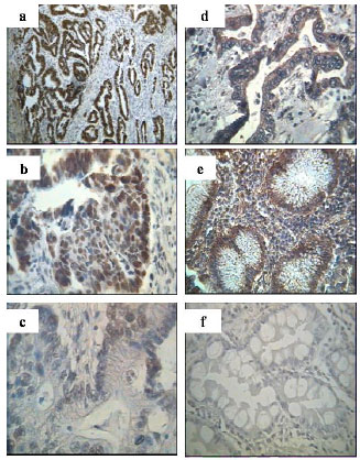 Image for - P-glycoprotein and Topoisomerase II α Expression in Advanced Gastric Cancer Patients: Association with Clinicopathological Findings