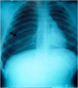 Image for - Spontaneous Pneumothorax in a Patient with Osteosarcoma During Treatment with Methotrexate