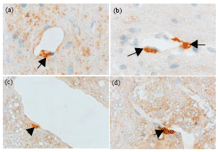 Image for - Effects of Acute Hyperglycemia on Blood Brain Barrier During Pentylenetetrazole-induced Epileptic Seizures