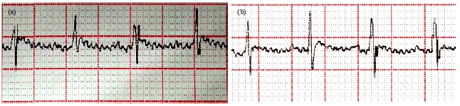 Image for - Normalization of QRS Segment, Blood Pressure and Heartbeat in an Experimental Model of Amitriptyline Intoxication in Rats Following Hyperbaric Oxygenation Therapy