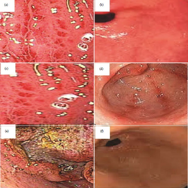 Image for - Zerumbone with Hydroxypropyl-β-Cyclodextrin Inclusion Complex as a Potential Treatment for Gastritis
