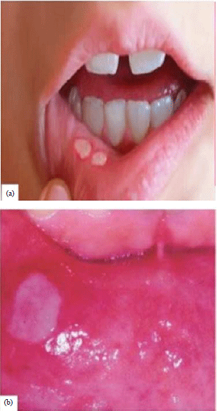 Image for - A Comparison of Immunomodulatory Monotherapy and Combination Therapy for Recurrent Aphthous Stomatitis