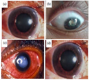 Image for - Efficacy and Safety of Intraocular Pressure-Lowering Agents Bimatoprost and Timolol Maleate in Glaucoma