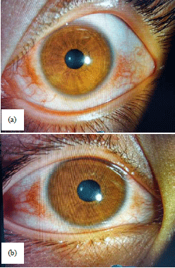 Image for - Comparing Efficacy and Safety of Olopatadine and Emedastine inPatients with Allergic Conjunctivitis