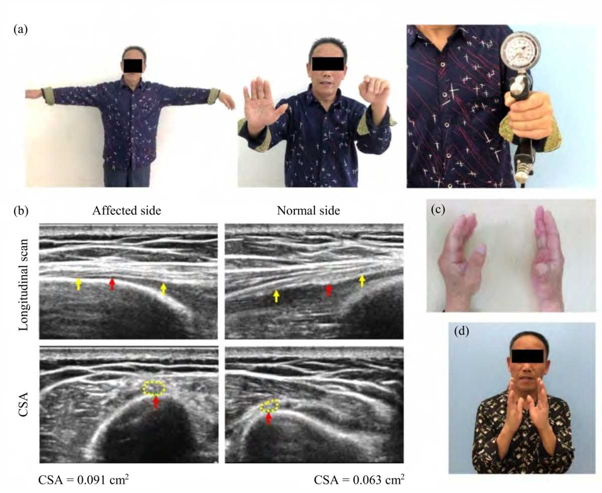 Prednisone Combined with Antiviral Agents for the Treatment of Early