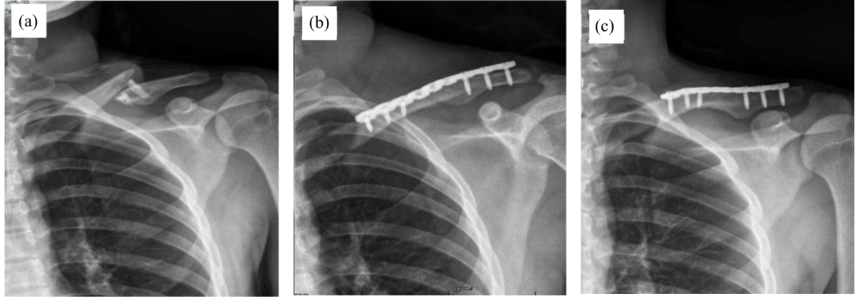 Image for - Clinical Experiences with Tranexamic Acid for Open Reduction and Internal Fixation of Clavicle Fractures