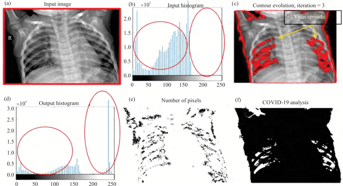 Image for - Predictive Analysis of COVID-19 Symptoms with CXR Imaging and Optimize the X-Ray Imaging Using Segmentation Thresholding Algorithm-An Evolutionary Approach for Bio-Medical Diagnosis