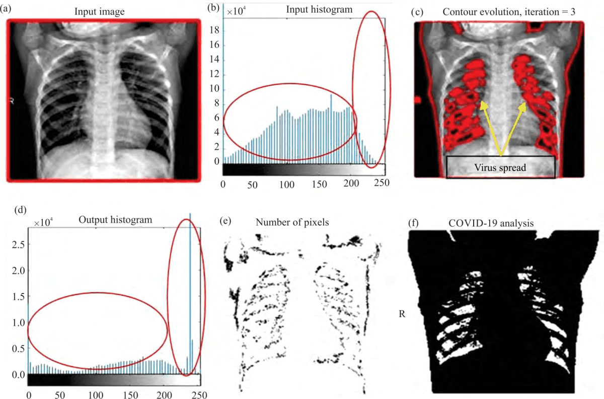 Image for - Predictive Analysis of COVID-19 Symptoms with CXR Imaging and Optimize the X-Ray Imaging Using Segmentation Thresholding Algorithm-An Evolutionary Approach for Bio-Medical Diagnosis
