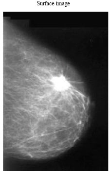 Image for - Mammogram Breast Cancer Image Detection Using Image Processing Functions