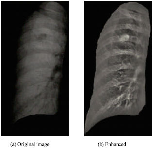Image for - Rib Suppression in Chest Radiographs Using ICA Algorithm