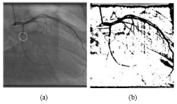 Image for - Backpropagation Network for Segmentation and Blood flow Velocity Determination in Coronary Angiogram Images