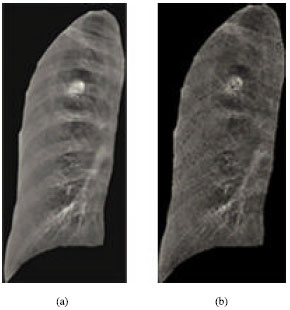 Image for - Rib Suppression in Chest Radiographs Using ICA Algorithm
