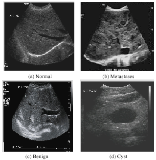 Image for - Automatic Classification of Focal Lesions in Ultrasound Liver Images Using Combined Texture Features