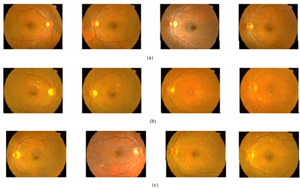 Image for - An Intelligent Approach to Detect Hard and Soft Exudates Using Echo State Neural Network
