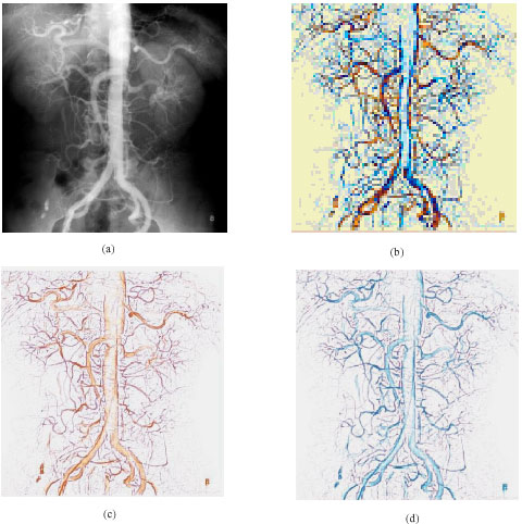 Image for - Enhancement of Angiogram Images Using Pseudo Color Processing