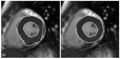 Image for - A Novel Method for Segmentation of the Cardiac MR Images using Generalized DDGVF Snake Models with Shape Priors