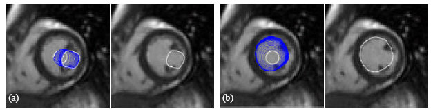 Image for - A Novel Method for Segmentation of the Cardiac MR Images using Generalized DDGVF Snake Models with Shape Priors