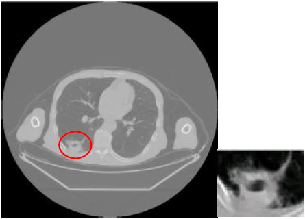 Image for - Computerized Distinction of Improved Fuzzy Support Machine for Imageology Character of Benign and Malighant Pulmonary Nodules