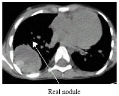 Image for - Image Processing for Synthesizing Lung Nodules: A Experimental Study