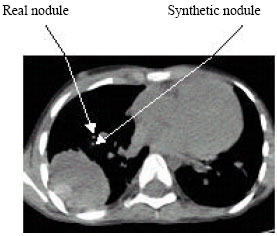Image for - Image Processing for Synthesizing Lung Nodules: A Experimental Study