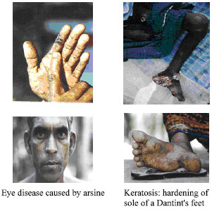 Image for - How Does Arsenic Contamination of Groundwater Causes Severity and Health Hazard in Bangladesh