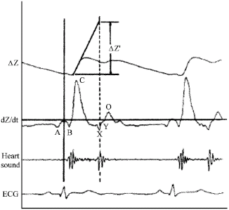 Image for - High Sensitivity and Noise Immune Method to Detect Impedance Cardiography Characteristic Points Using Wavelet Transform