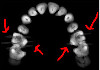 Image for - Rapid Automatic Segmentation and Visualization of Teeth in CT-Scan Data