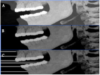 Image for - Fully Automatic Extraction of Panoramic Dental Images from CT-Scan Volumetric Data of the Head