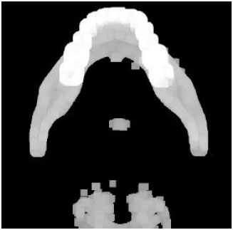 Image for - Fully Automatic Extraction of Panoramic Dental Images from CT-Scan Volumetric Data of the Head