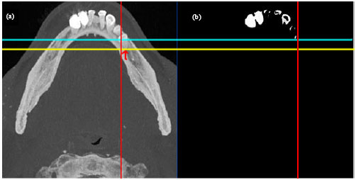 Image for - Rapid Automatic Segmentation and Visualization of Teeth in CT-Scan Data