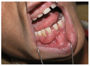 Image for - Gingival Ancient Schwannoma: Review of Literature and a Case Report