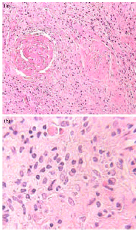Image for - Gingival Ancient Schwannoma: Review of Literature and a Case Report