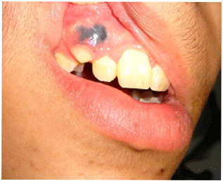 A Problematic Oral Pigmentation: Deep Penetrating Nevus