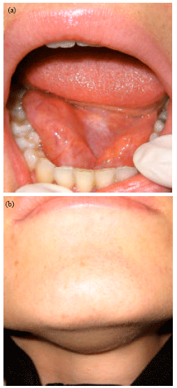 Image for - Ectopic Thyroid in Submandibular and Sublingual Region: Report a Case and Review of Literatures