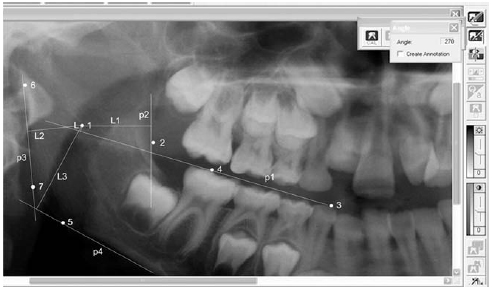 Image for - Locating the Mandibular Foramen Relative to the Occlusal Plane using Panoramic Radiography