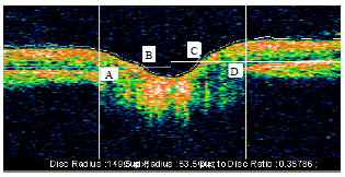 Image for - Automatic Detection of Glaucoma Using Optical Coherence Tomography Image