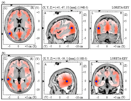 Image for - Cortical Activation of Level-to-Contour Tone Changes in Different Vowel Duration Indexed by Mismatch Negativity