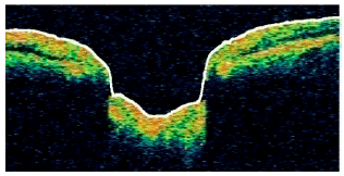 Image for - Automatic Detection of Glaucoma Using Optical Coherence Tomography Image
