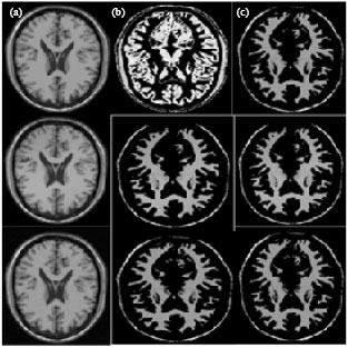 Image for - Segmentation of MRI Brain Images Using FCM Improved by Firefly Algorithms