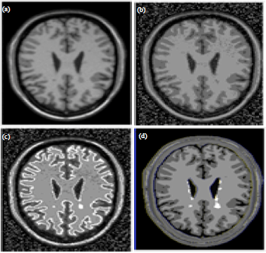 Image for - MRI Brain Segmentation Using a Hybrid Artificial Bee Colony Algorithm with Fuzzy-C Mean Algorithm