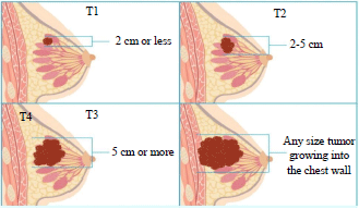 Image for - Data Mining Techniques in Predicting Breast Cancer